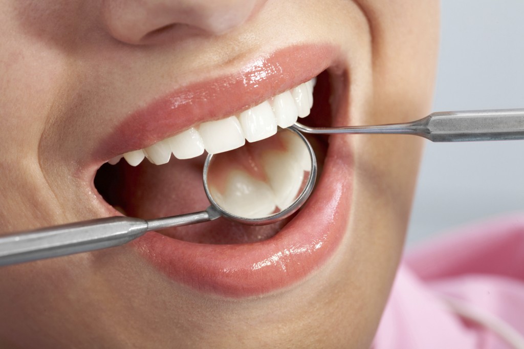 faqs about fillings