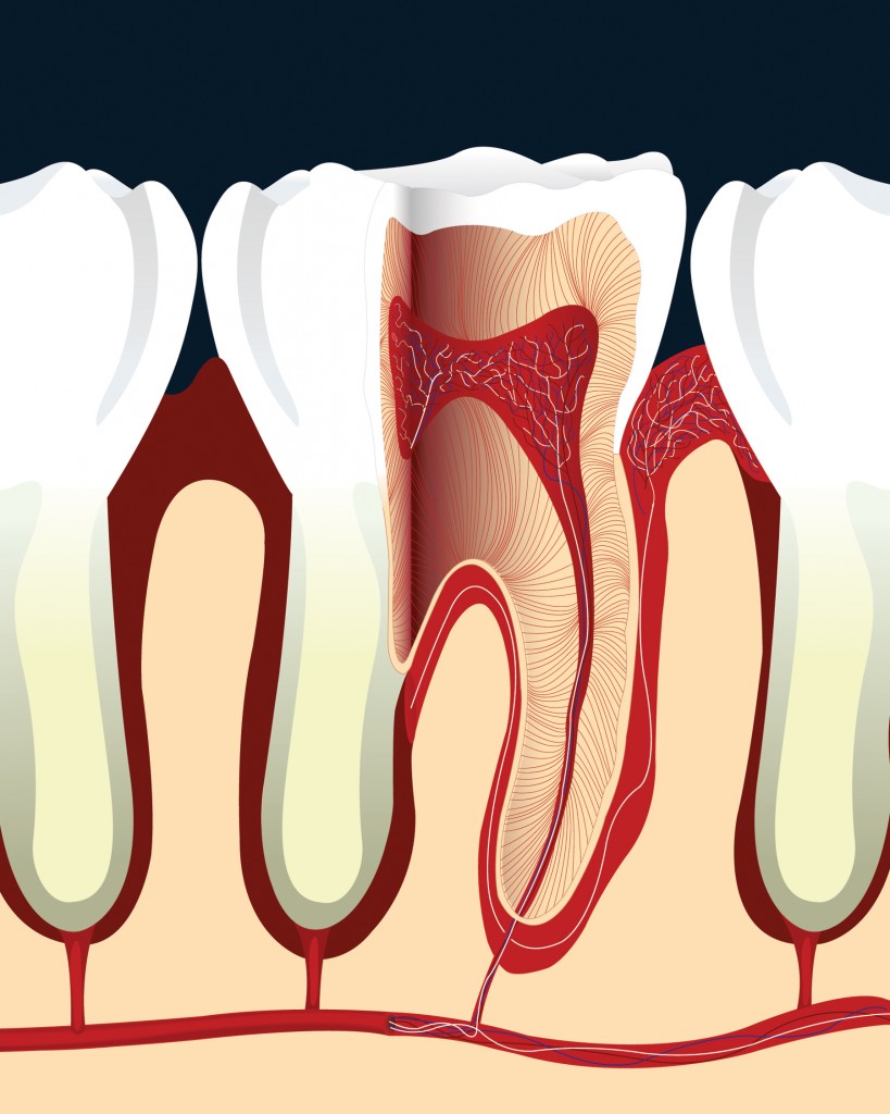 root canal therapy