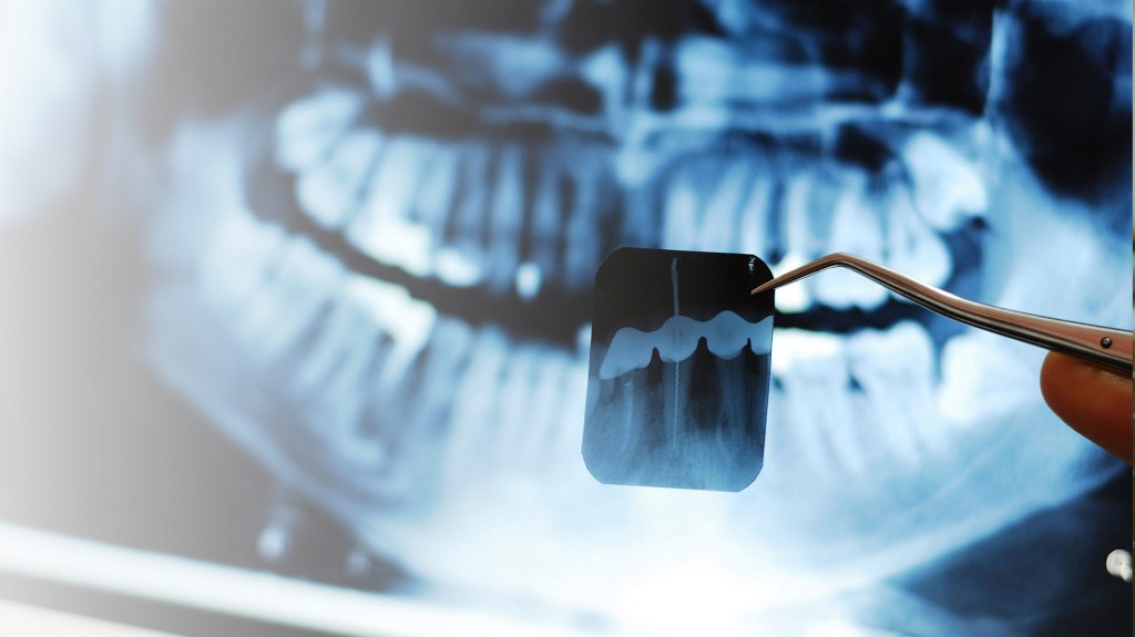 root canal