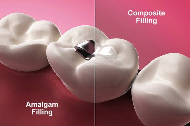 white filling or silver filling