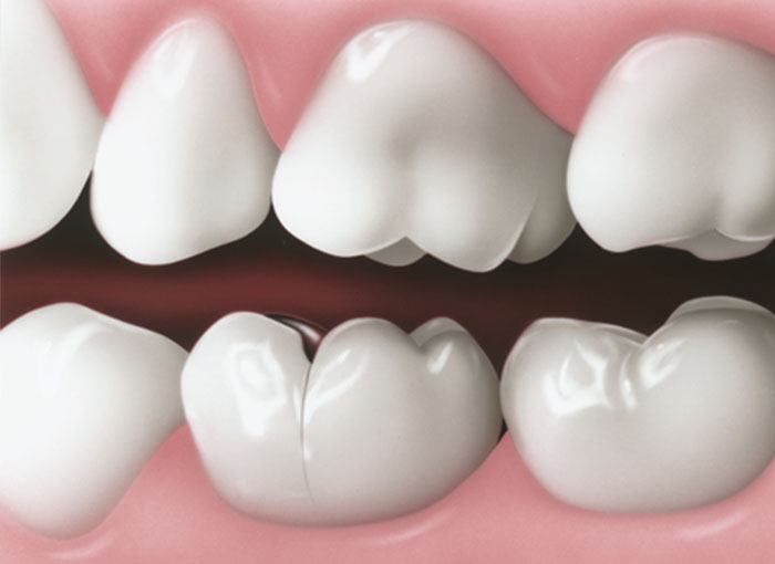 cracked tooth