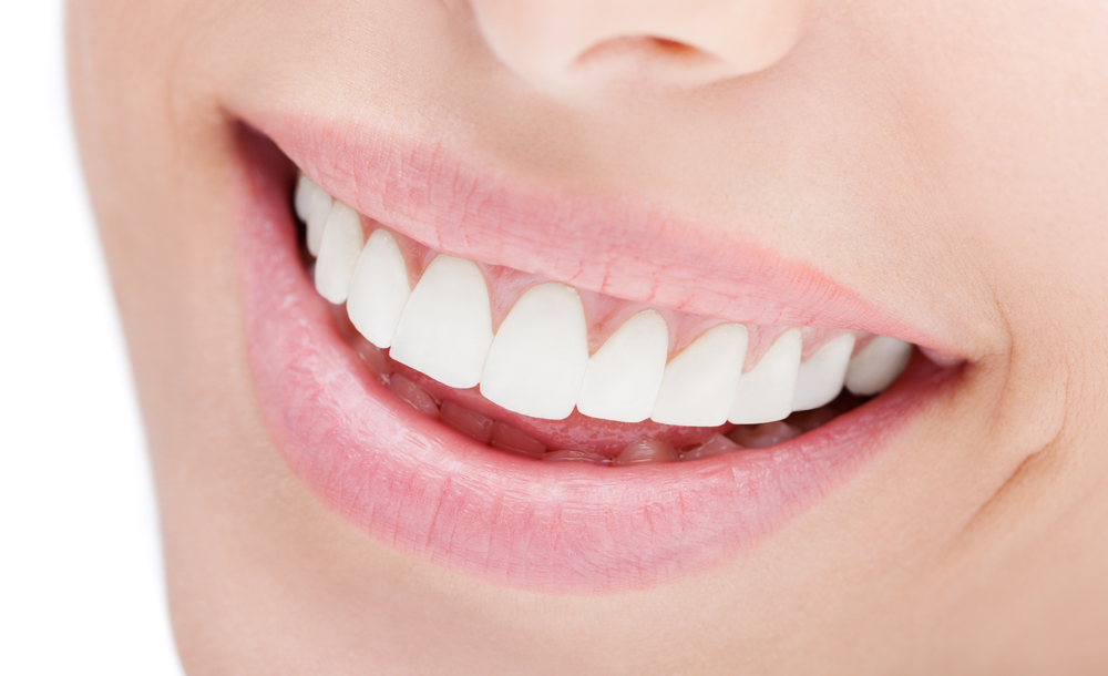 porcelain veneers