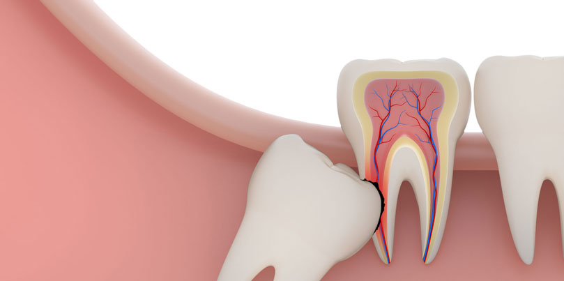 wisdom tooth extraction