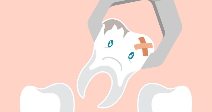 tooth extraction