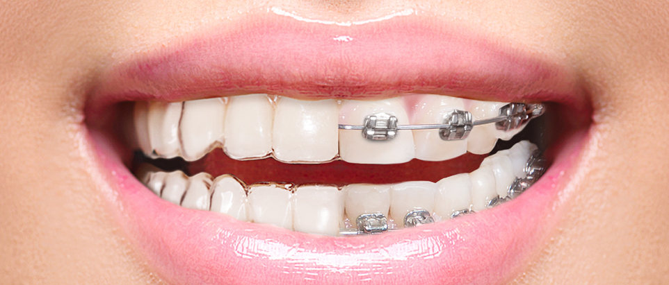 teeth straightening