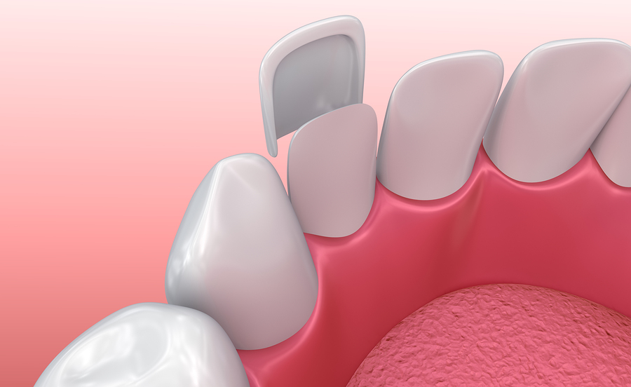 Why would I need dental veneers?