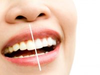Teeth whitening: what colour should my teeth be and is it safe to whiten them?