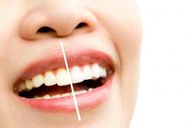 teeth whitening: what colour should my teeth be and is it safe to whiten them