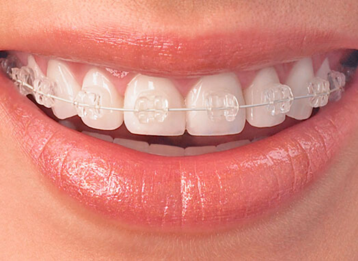 Traditional Orthodontic Braces Melbourne - Core Dental