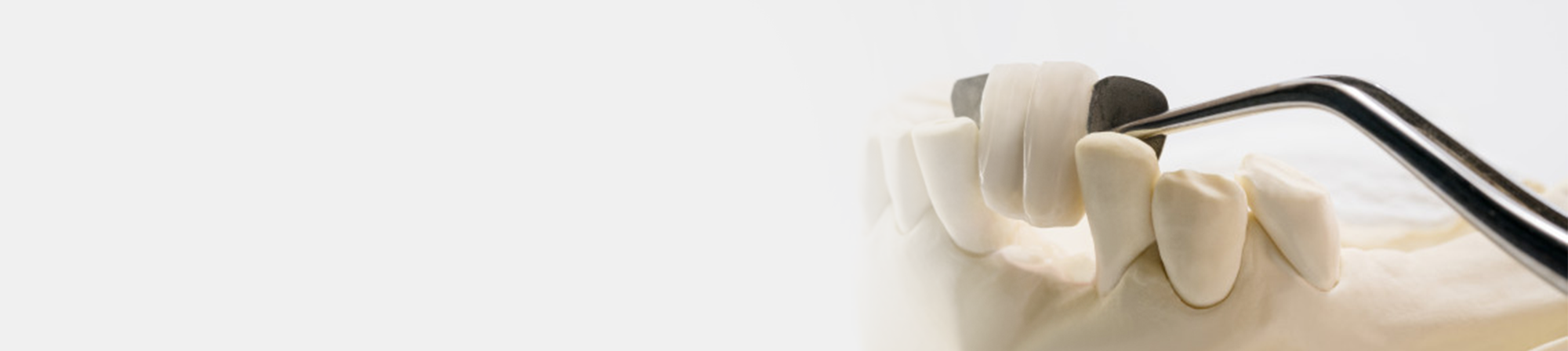 Dental Bridges - Missing Tooth Replacement Treatment